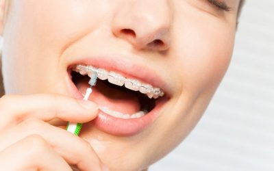 Appareil fixe et hygiène bucco-dentaire